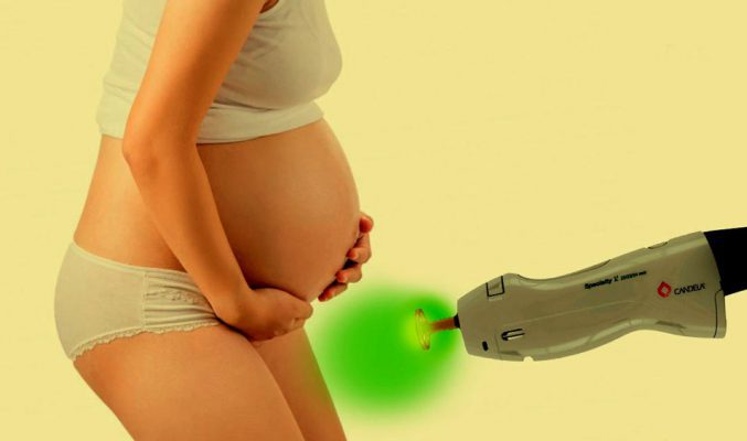 لیزر در کدام نواحی بارداری حساستر است؟